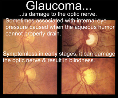 Glaucoma Pics