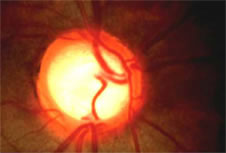 Glaucoma Pics