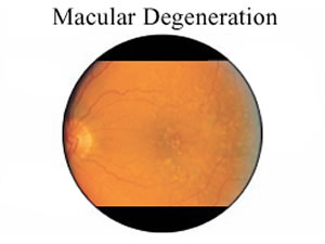 Eye Types