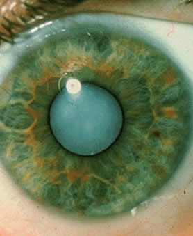 Eye Types
